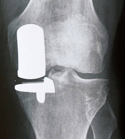 X-ray of Biomet Oxford Partial Knee Replacement
