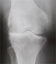 X-ray of Knee With Arthritis