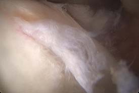 Arthroscopic View of Hip Labral Tear