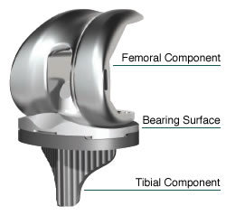 Knee Replacement Components