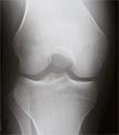 X-ray of Knee Without Arthrits